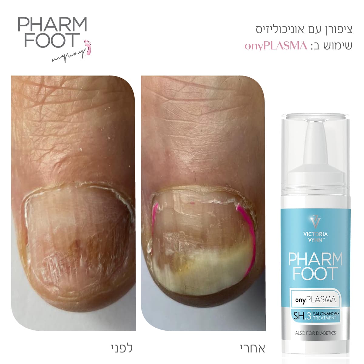 נוזל קולוסטרום לשיקום הציפורן וטיפול באוניכוליזיס - Pharm Foot | 15 ml | onyPLASMA photo number 1